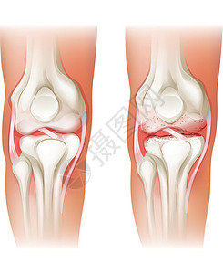 肌肉无力人膝关节炎插画