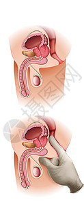 前列腺特异性生长缓慢勃起功能障碍高清图片