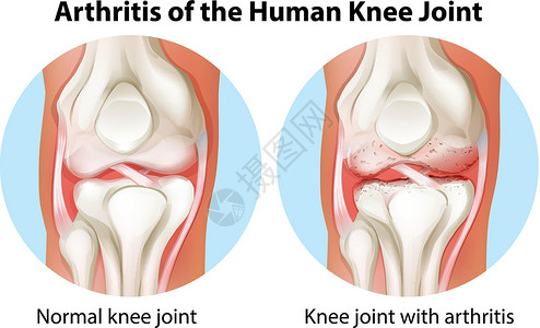 蓬泰诺沃人类膝关节的关节炎加入插画