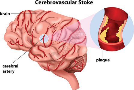 血液供应脑卒中插画