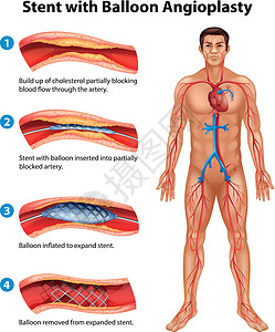 支架血管成形术药品心脏病外科手术导管硬化牌匾插图医生动脉背景图片