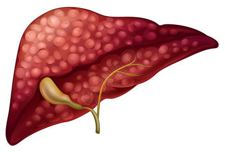 胰腺癌人类硬化癌插画