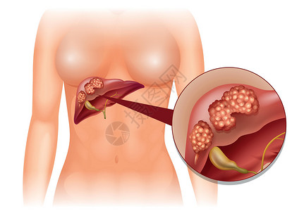 肝癌详细图解女士科学绘画艺术症状图表医疗疾病生物夹子背景图片