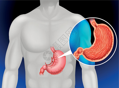 人类胃癌科学生物卡通片生物学插图图表夹子绘画癌症x光背景图片