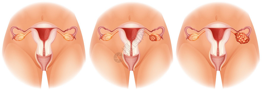 Overian 癌症分三期高清图片
