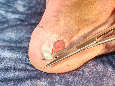 奔跑剪映护士帮助忍受脚跟皮肤擦伤的病人治疗病变护发素消毒糖尿病男生危险粉刺水疱身体背景