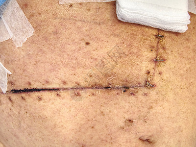 胆囊和肠胃手术后腹部有伤疤的病人高清图片