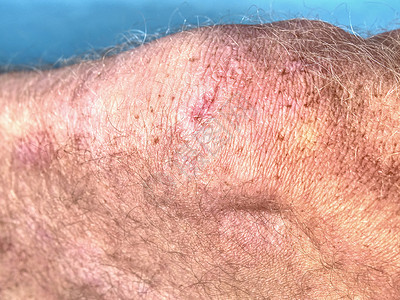 皮肤溃疡人类皮肤上的粉红疤痕 人类皮肤烧伤的疤痕背景