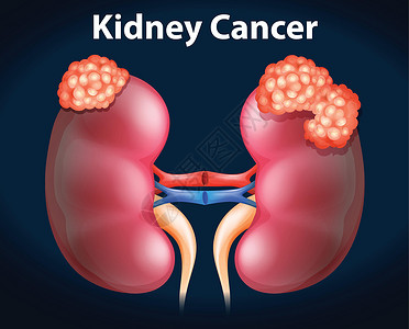 显示肾癌的图表海报器官生物学医疗x光插图生物艺术疾病科学插画