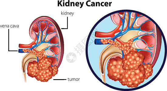 显示肾癌的图表器官生物夹子医生剪裁插图健康人体科学小路插画