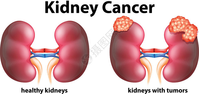 显示人类肾癌的图表小路解剖学医疗技术艺术疾病医生生物插图夹子插画