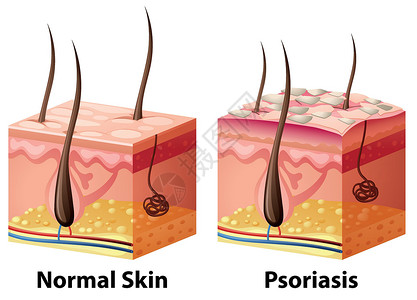 正常和牛皮癣的人体皮肤图背景图片