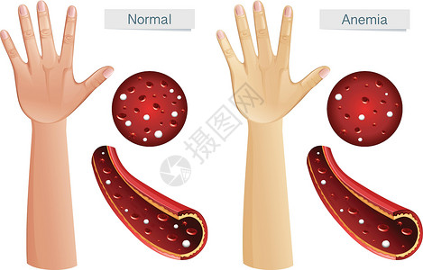血蛋白Anemi 的人体解剖学载体插画