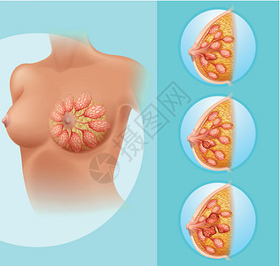 胸部x光女性乳腺癌生物疾病人体绘画女士科学插图癌症器官生物学插画