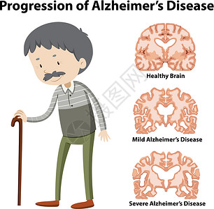 老痴呆症阿尔茨海默病的进展科学老年保健医院状况治疗医生插图绘画夹子插画