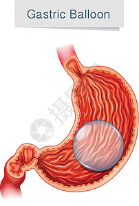 吃坏肚子解剖医学载体胃球插画