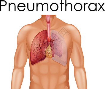 气胸的人体解剖学插画
