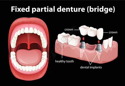 差距固定局部义齿的医学载体插画