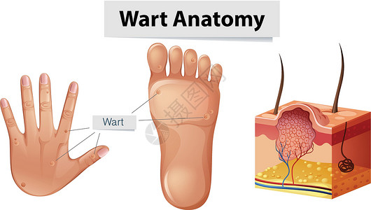 跖疣手上的人体解剖学疣和 Foo设计图片