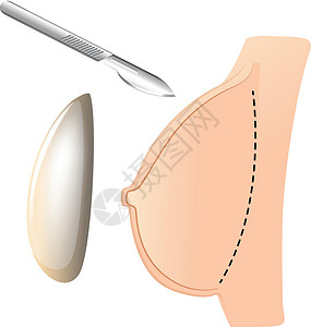 植入物和手术刀隆胸插画