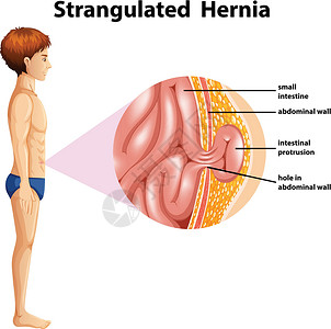 人体解剖绞死 Herni高清图片