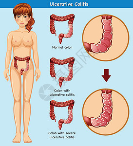 溃疡性的溃疡性结肠炎的人体解剖学插画
