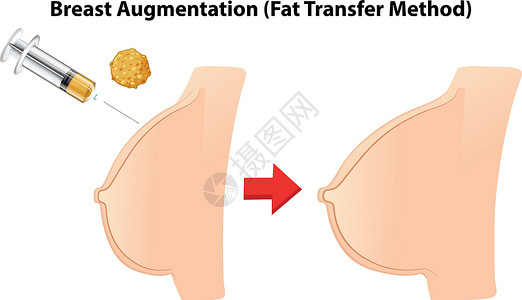 隆胸手术隆胸脂肪移植法医疗绘画艺术切口方法手术女士乳腺身体塑料插画