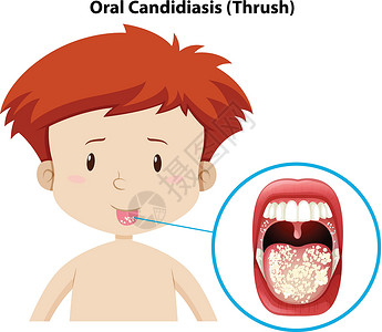 酵母菌患有口腔念珠菌的小男孩插画