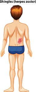 带状的背带状疱疹的男人插画