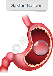 吃坏肚子人体解剖学胃气球它制作图案插画
