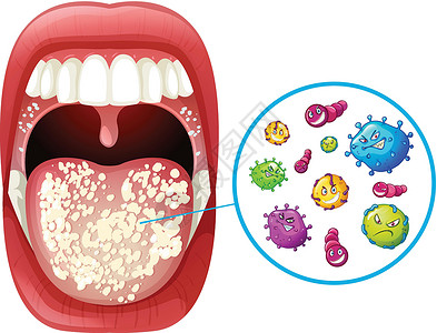 人类口腔病毒感染疾病夹子药品绘画医学微生物空腔科学牙医怪物插画