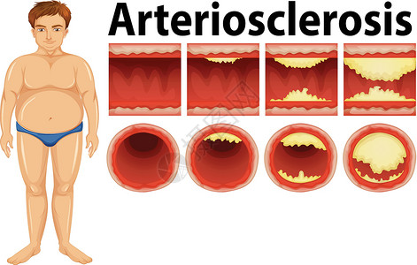 脂类一个患有动脉粥样硬化的胖子插画