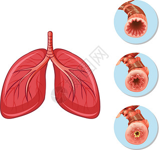 每到佳节胖三斤阻塞气道到肺的阶段插画