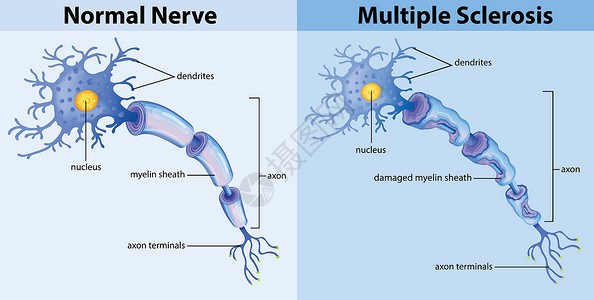 髓鞘正常神经和多发性硬化症插画
