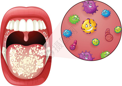 人类口腔病毒感染空腔流感药品科学癌症微生物夹子怪物牙医发烧插画