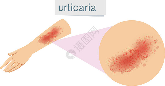 自身人类皮肤问题荨麻疹插画