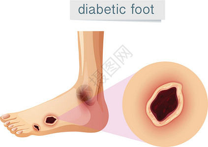 脚受伤的素材在 foo 上放大的糖尿病足插画