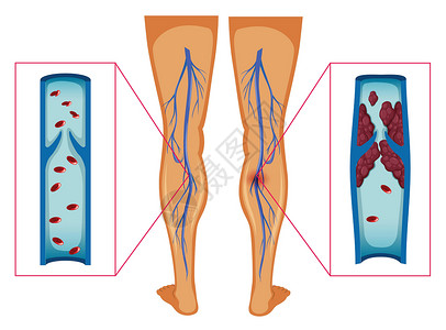 人的腿显示人腿血凝块的图表图插画