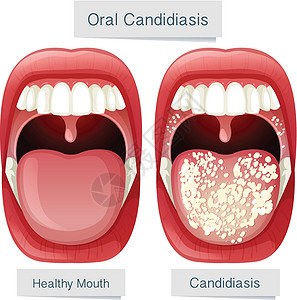 舌头疾病人类口腔解剖口插画