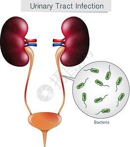 白底尿路感染疾病生物学身体小便池图表女性尿道夹子细菌尿液插画