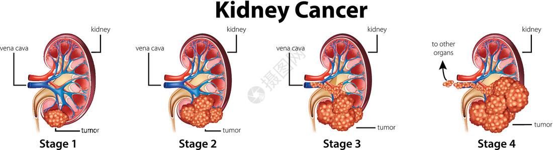 显示肾癌不同阶段的图表插画