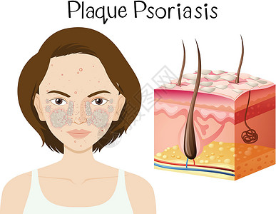 皮肤瑕疵银屑病斑块的人体解剖学卵泡疾病缺陷真皮夹子卫生头发皮肤状况感染插画
