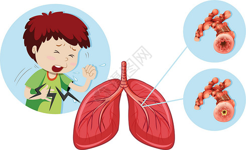 栓塞一名患有慢性阻塞性肺病的男子插画