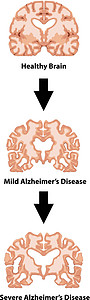 阿尔茨海默氏病的阶段高清图片
