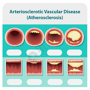 显示动脉硬化性血管疾病的图表插画