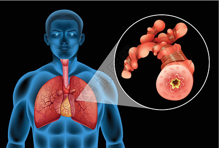 肺部x光肺部有肿瘤的人插画