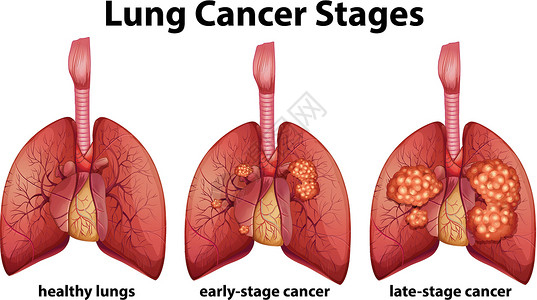 疾病剪贴画显示肺癌分期的图表插画