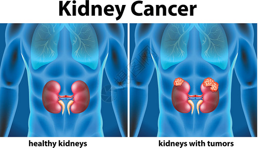 显示人类肾癌的图表医生医疗插图人体解剖学疾病科学健康器官绘画插画