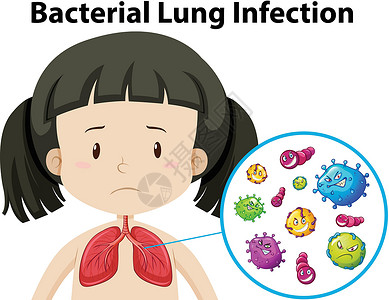 排放量细菌性肺部传染媒介插画