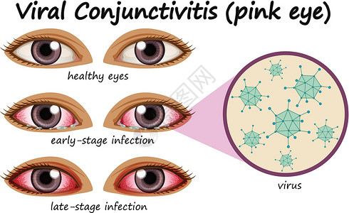 带有病毒性结膜炎的人类眼病插画
